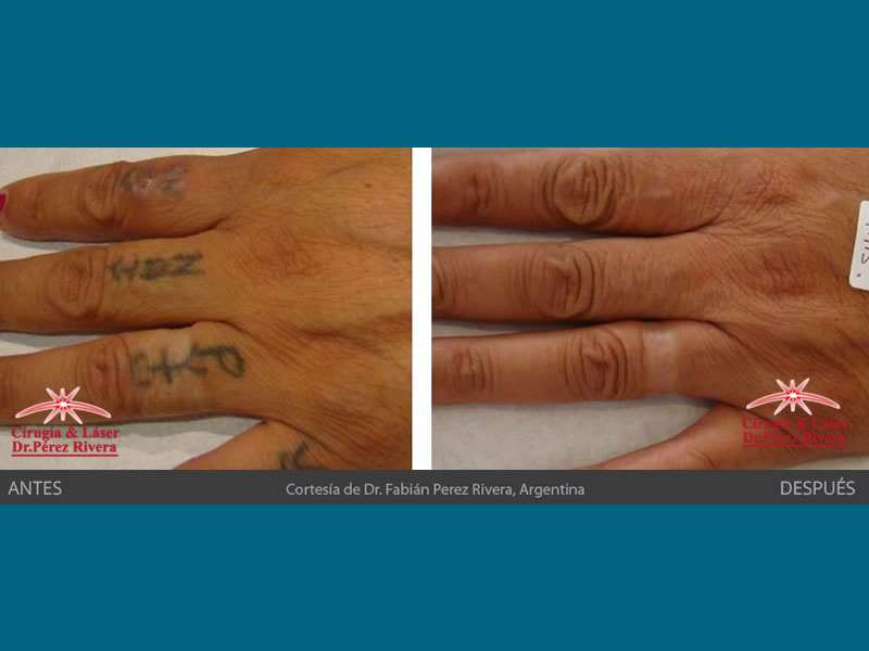 Galería de fotos Antes y Después :: Borrado tatuajes con láser